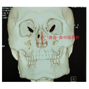 貴陽銘仁耳鼻喉醫(yī)院提醒您：鼻子很脆弱，要好好保護