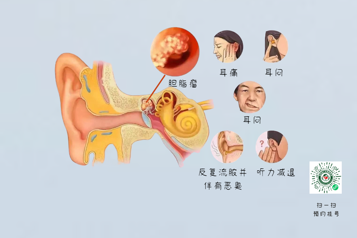 手術(shù)沒(méi)做干凈，術(shù)后3年顱內(nèi)竟發(fā)現(xiàn)巨大膽脂瘤！(圖6)