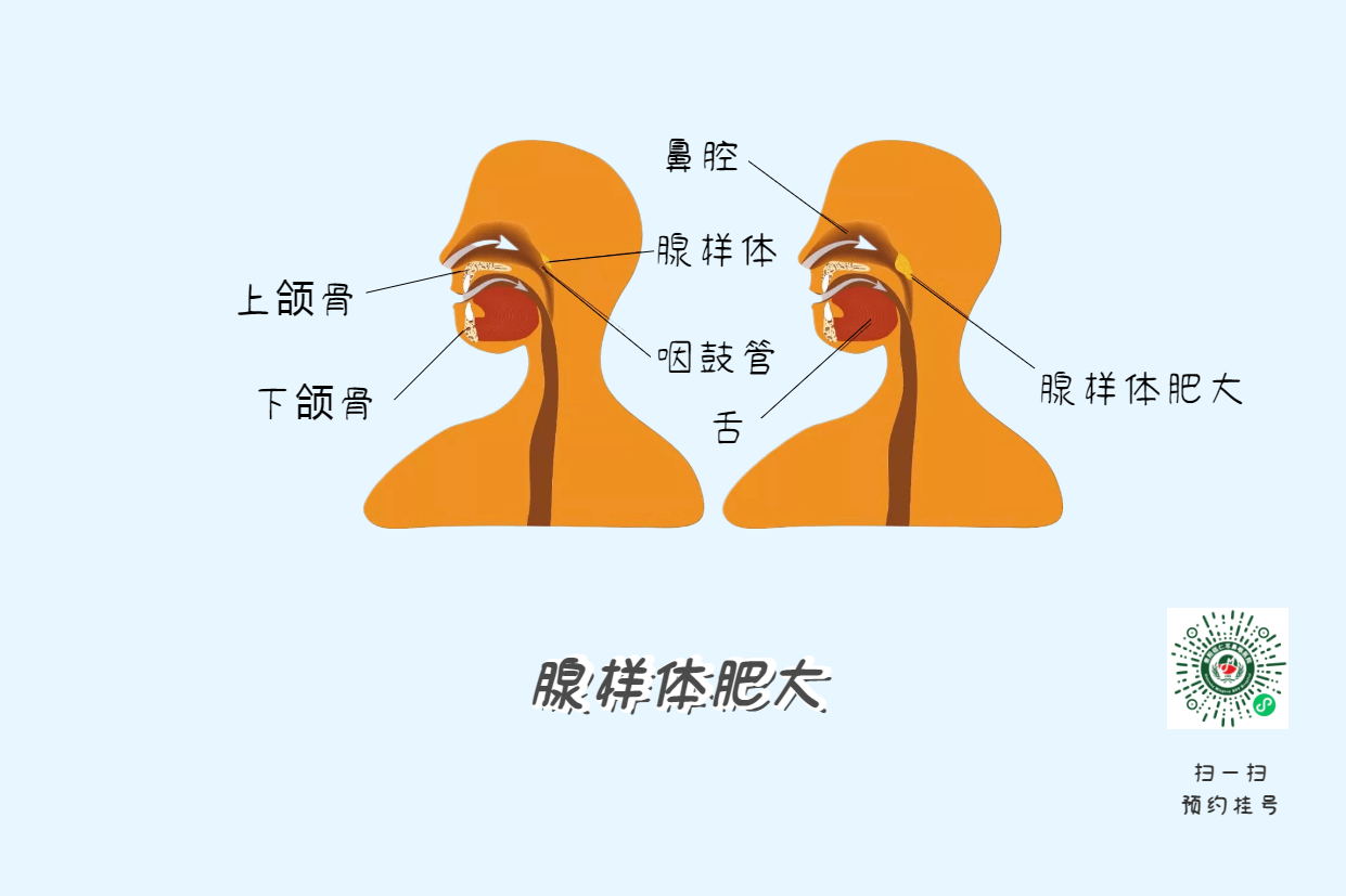 暑假來了，孩子腺樣體肥大到底切不切？(圖4)