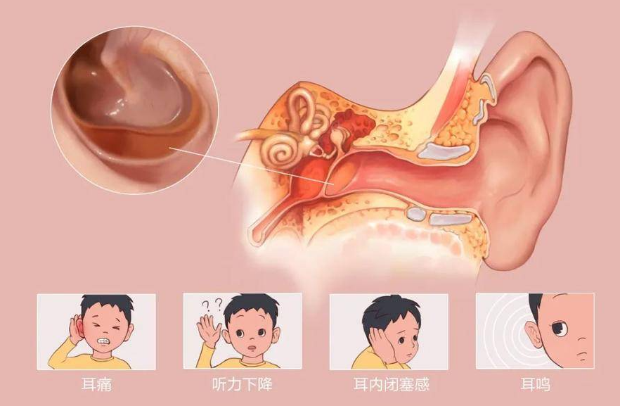 耳朵里耳屎多，到底要不要掏，正確處理方式是？(圖2)