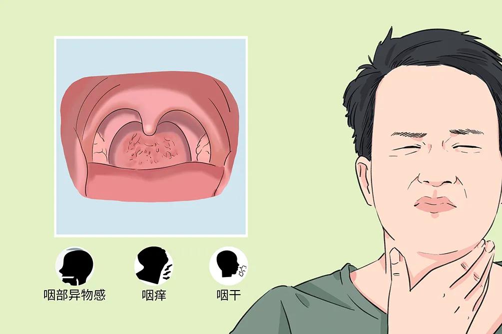 專家分享：咽炎難說“再見” 要對(duì)癥治療(圖2)