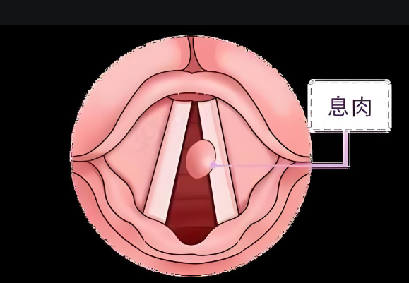 聲音嘶啞、嗓子難受，聲帶息肉不可小覷(圖1)